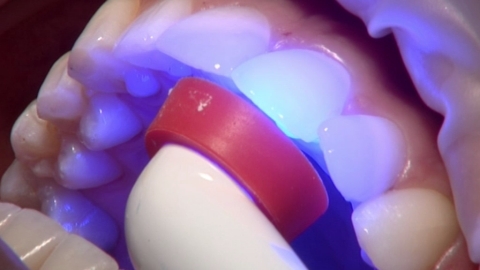 DMG introduce cutting edge treatment that could mean the dentist's drill is a thing of the past